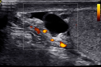 Фото: Эпидидимит на УЗИ