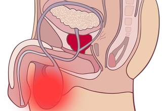Фото: Орхит и эпидидимит